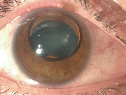 Ectopia Lentis et Pupillae: A Rare Bilateral Mismatch Between Lens and Pupil