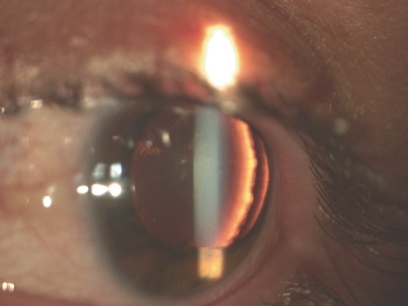 Clinical eye photograph illustrating Ectopia Lentis et Pupillae