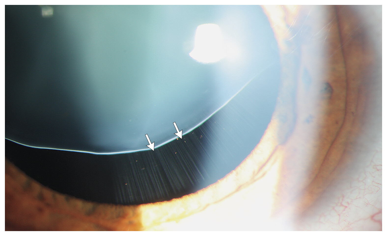 Ectopia lentis: slit-lamp view of the subluxated lens edge with exposed zonular fibers marked by arrows