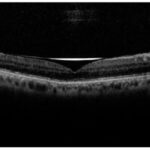 Ellipsoid zone disruption: macular OCT B-scan showing the layered outer retinal bands at the fovea
