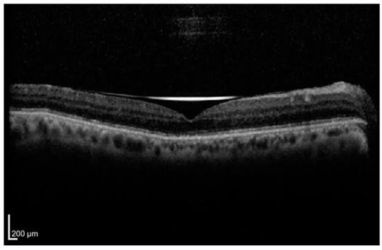 Ellipsoid Zone Disruption on OCT: What Photoreceptor Loss Looks Like and What It Predicts