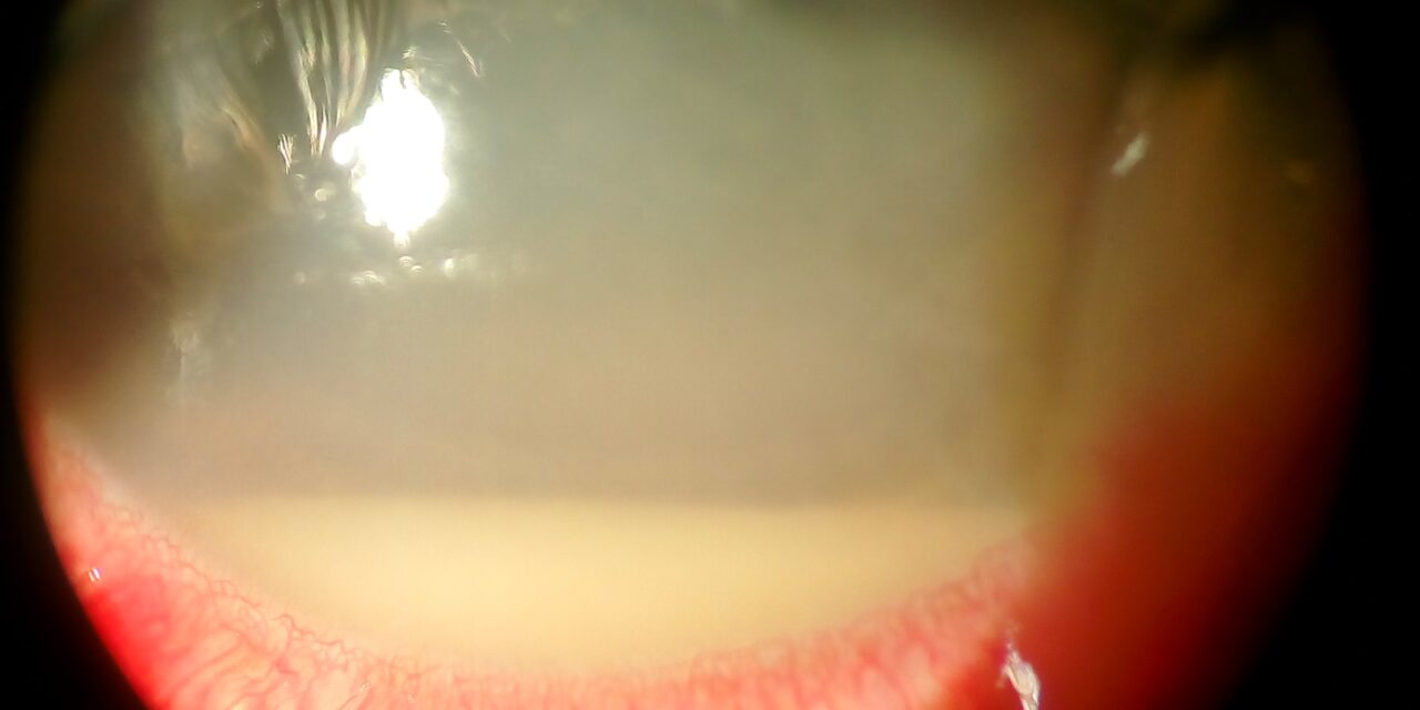 Endogenous vs Exogenous Endophthalmitis: Same Infection, Different Route In