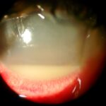 Endophthalmitis: slit-lamp photograph of a dense hypopyon with fibrin and corneal edema