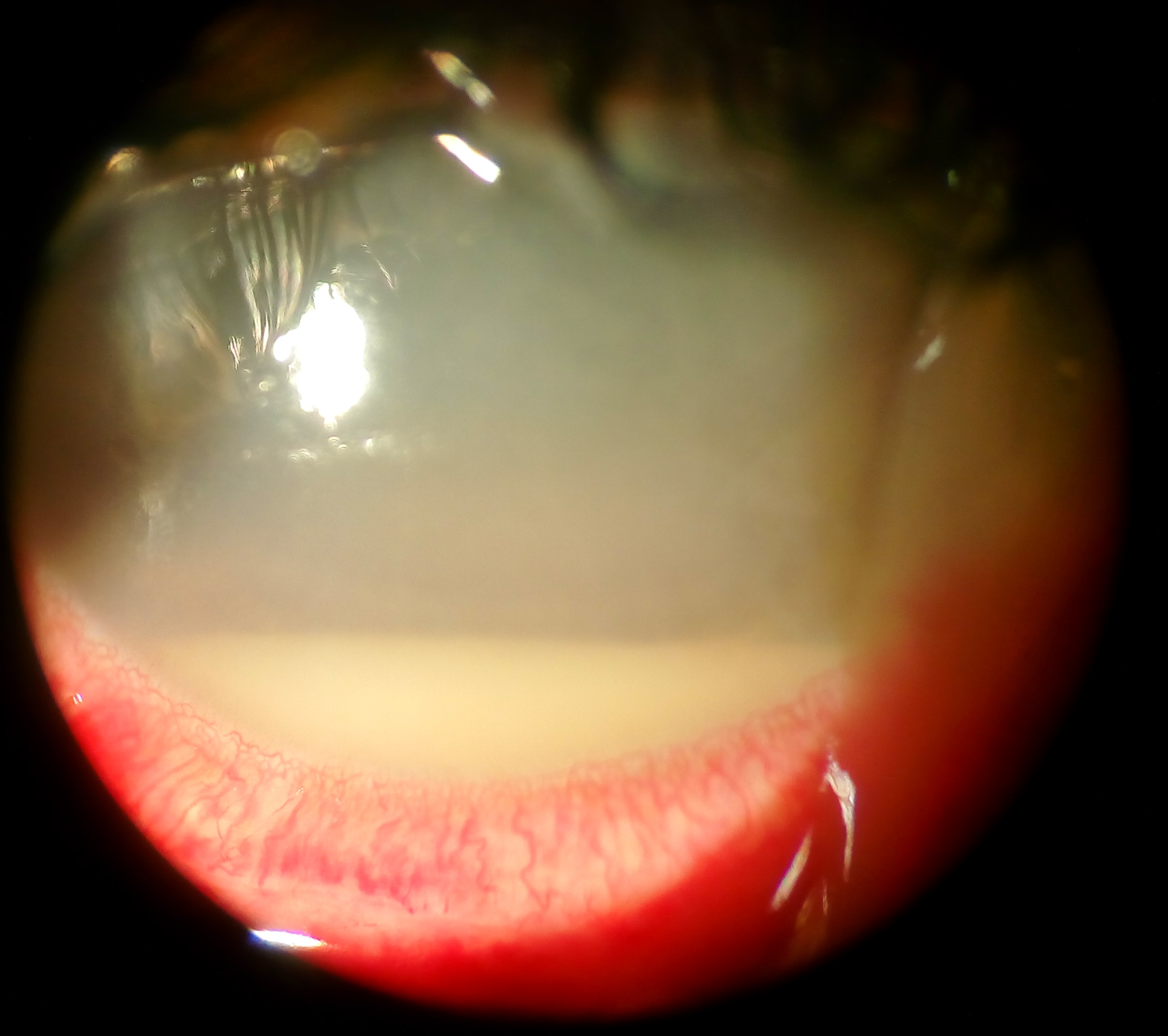 Endophthalmitis Hypopyon and Fibrin Endophthalmitis: slit-lamp photograph of a dense hypopyon with fibrin and corneal edema