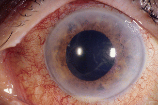 Endophthalmitis Red Eye and Corneal Haze Endophthalmitis: red eye with diffuse corneal haze and a dilated pupil