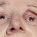 Enophthalmos: upgaze view showing a deeper superior sulcus and a sunken appearance of one eye