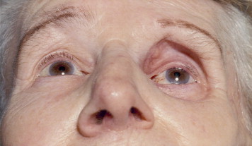 Enophthalmos: The Volume Problem Behind a Sunken Eye