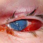 Enucleation and evisceration: severely damaged blind eye with subconjunctival hemorrhage and corneal opacification