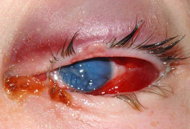 Enucleation and Evisceration: Two Ways to Remove an Eye, and Why It Matters Which