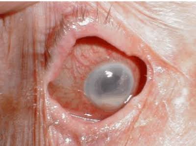 Enucleation and evisceration: end-stage eye with corneal opacification and a shrunken appearance