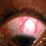 Clinical eye photograph illustrating Episcleral Venous Pressure Elevation Glaucoma
