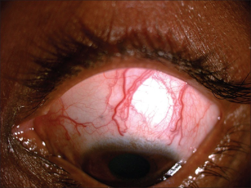 Clinical eye photograph illustrating Episcleral Venous Pressure Elevation Glaucoma