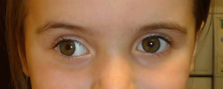 Exotropia: child with one eye deviated outward while the other eye fixates