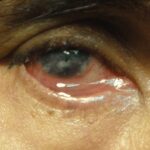 Exposure keratopathy: injected eye with incomplete lid closure and a hazy inferior cornea