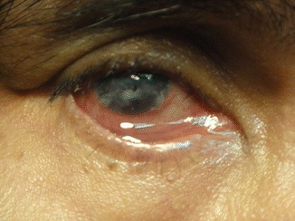 Exposure Keratopathy: When the Lids Can’t Cover the Cornea