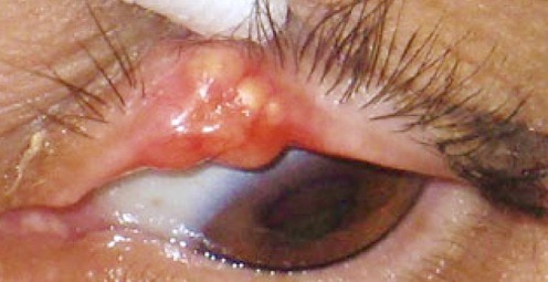 Sebaceous Carcinoma