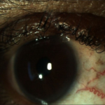 Clinical eye photograph illustrating Eyelid Margin Tumor Mohs Reconstruction