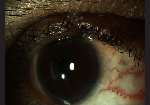 Eyelid Margin Tumors: Choosing the Right Reconstruction After Mohs Surgery