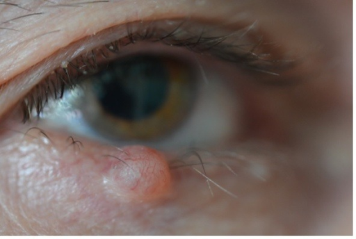 Clinical eye photograph illustrating Eyelid Margin Tumor Mohs Reconstruction