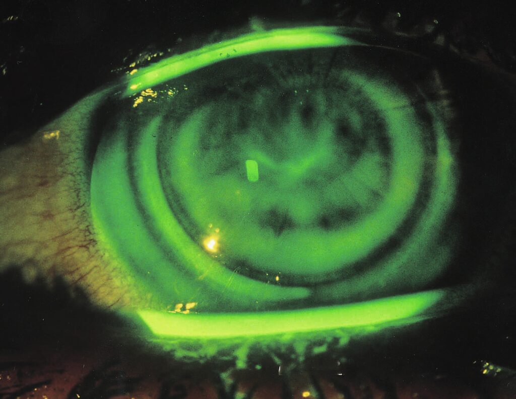 Contact Lens-Induced Corneal Warpage