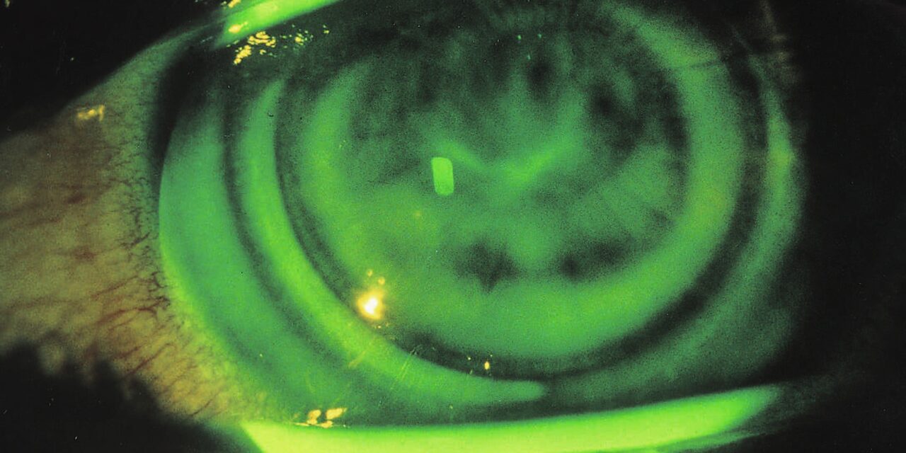 Contact Lens-Induced Corneal Warpage: The Reversible Keratoconus Look-Alike
