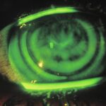 Contact Lens-Induced Corneal Warpage
