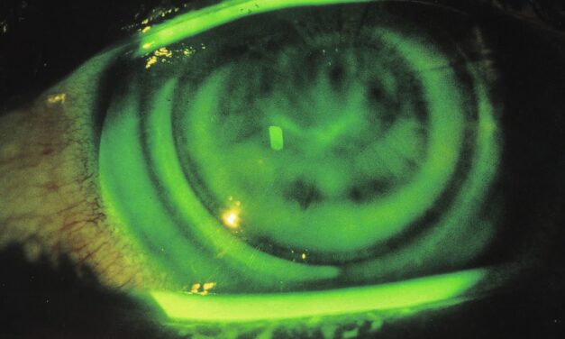 Contact Lens-Induced Corneal Warpage: The Reversible Keratoconus Look-Alike