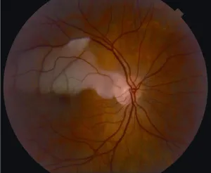 Cilioretinal Artery Occlusion