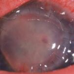 Corneal Wound Dehiscence