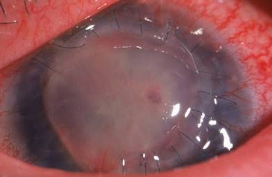 Corneal Wound Dehiscence: Why Old Surgical Scars Never Fully Regain Strength