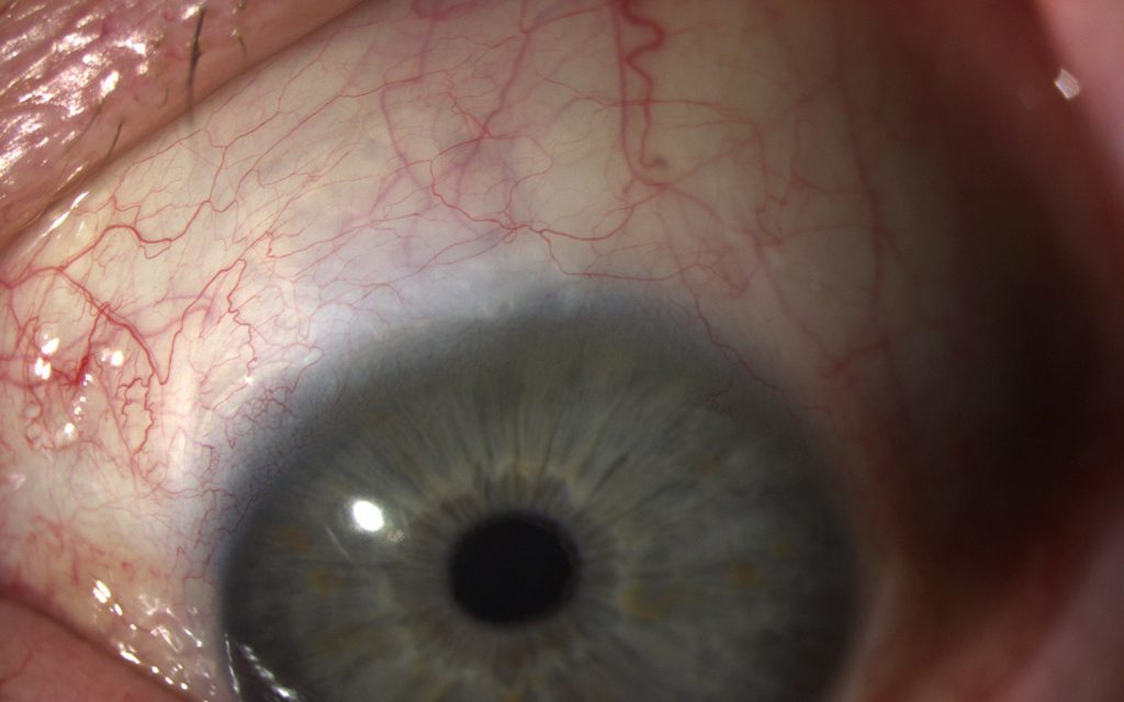 Canaloplasty: Reopening Schlemm’s Canal Without a Bleb