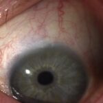 Canaloplasty