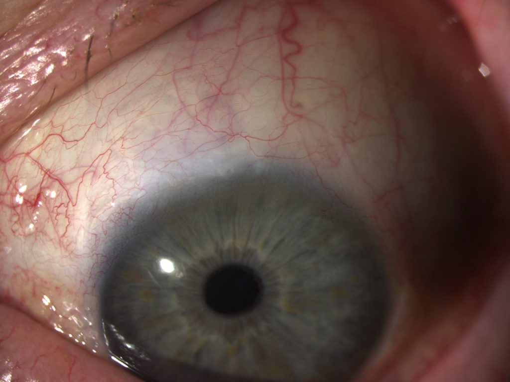 Canaloplasty