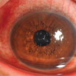 Clinical eye photograph illustrating Filamentary Keratitis Dry Eye Association