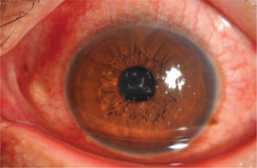 Clinical eye photograph illustrating Filamentary Keratitis Dry Eye Association