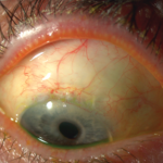Blebitis