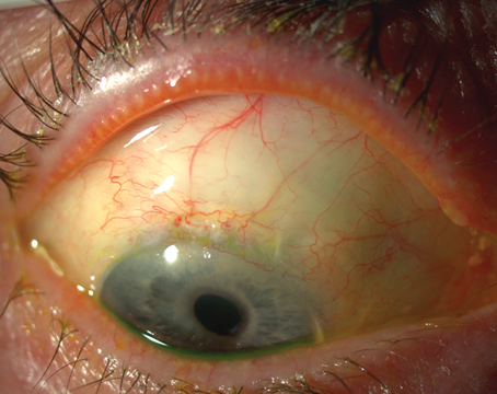 Blebitis: The Infection a Filtering Bleb Never Stops Risking