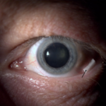 Clinical eye photograph illustrating Floppy Iris Syndrome Tamsulosin Cataract Surgery