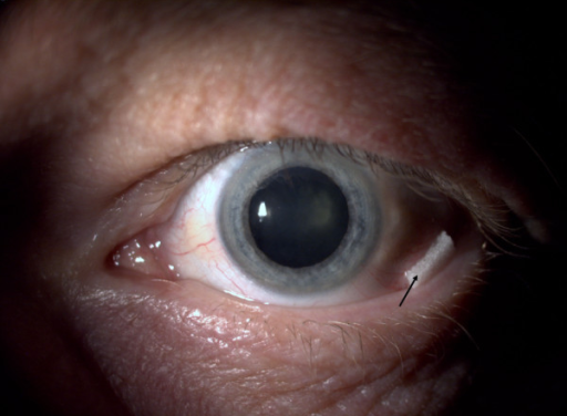 Intraoperative Floppy Iris Syndrome: What Tamsulosin Does to Cataract Surgery