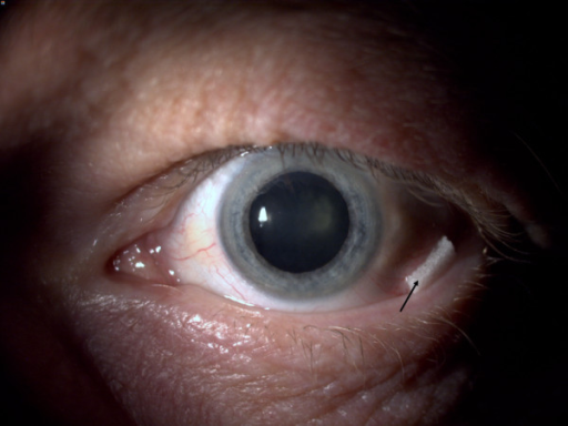 Intraoperative Floppy Iris Syndrome: What Tamsulosin Does to Cataract Surgery