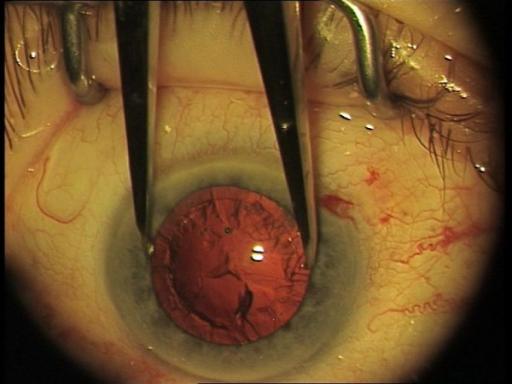 Clinical eye photograph illustrating Floppy Iris Syndrome Tamsulosin Cataract Surgery