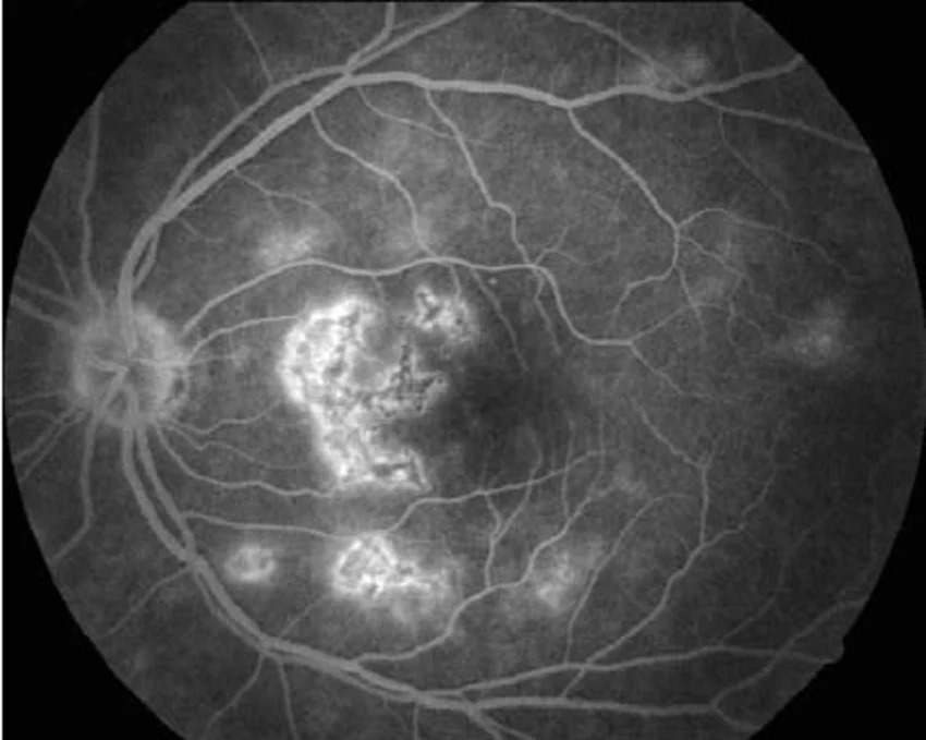 Fluorescein Angiography Late-Phase Staining Fluorescein angiography: late-phase frame of the left eye showing staining of plaques in the macula and around the disc