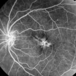 Fluorescein angiography: angiogram with a focal hyperfluorescent lesion at the macula and normal retinal vessel filling