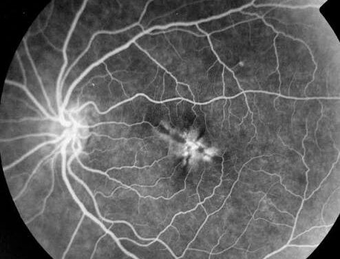Fluorescein Angiography: Reading the Patterns of Leakage, Blockage and Staining