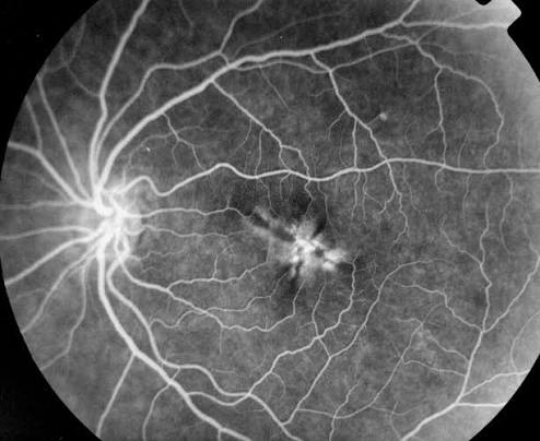 Fluorescein Angiography Macular Hyperfluorescence Fluorescein angiography: angiogram with a focal hyperfluorescent lesion at the macula and normal retinal vessel filling