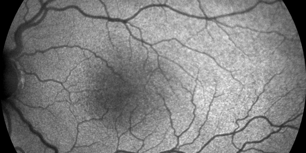 Foveal Hypoplasia in Albinism: What OCT Adds to a Clinical Diagnosis