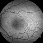Clinical eye photograph illustrating Albinism Foveal Hypoplasia Oct