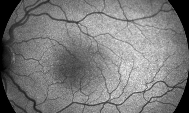 Foveal Hypoplasia in Albinism: What OCT Adds to a Clinical Diagnosis