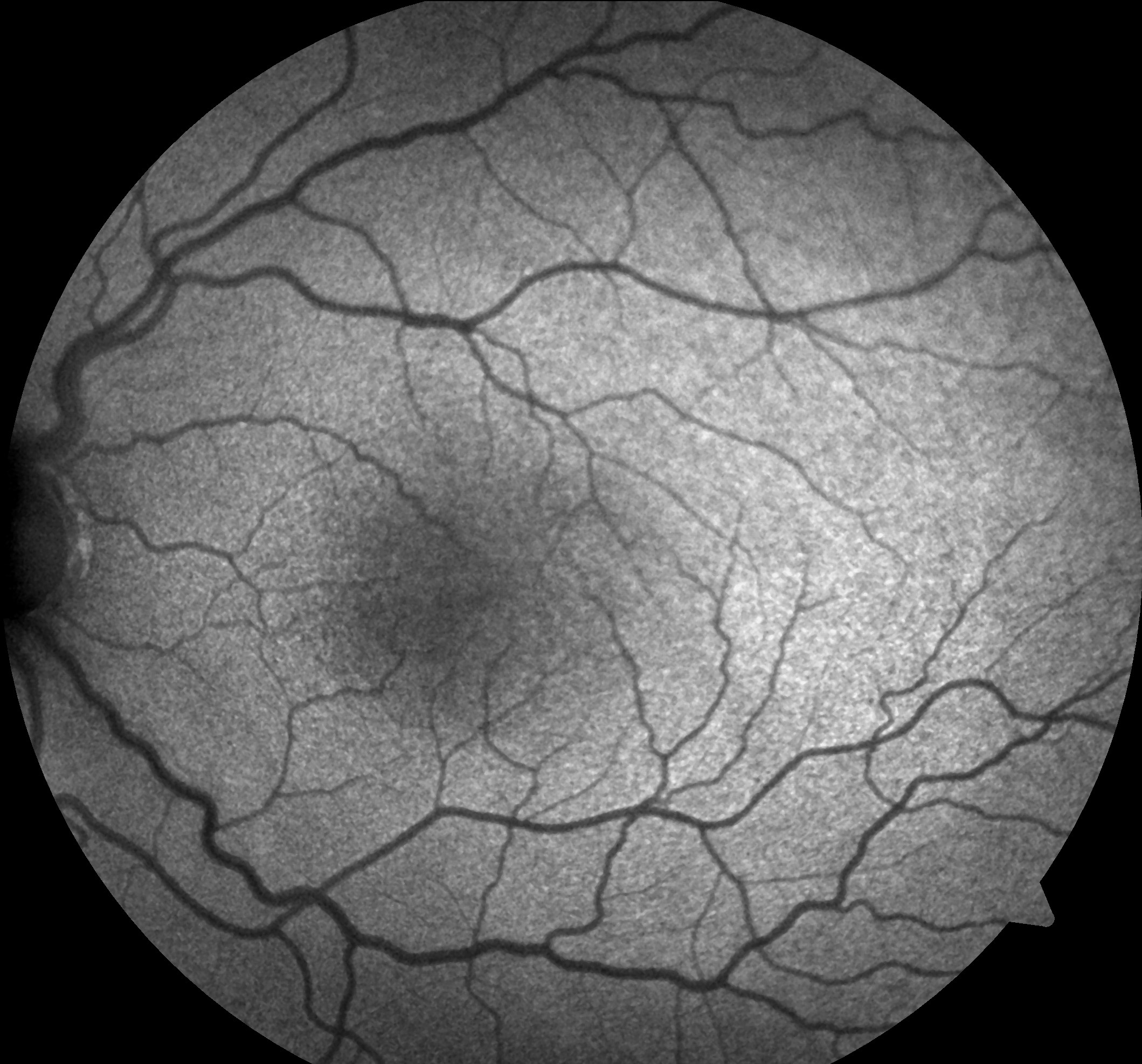 Clinical eye photograph illustrating Albinism Foveal Hypoplasia Oct