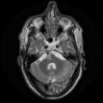 Foville syndrome: axial T2-weighted MRI of the pons and posterior fossa